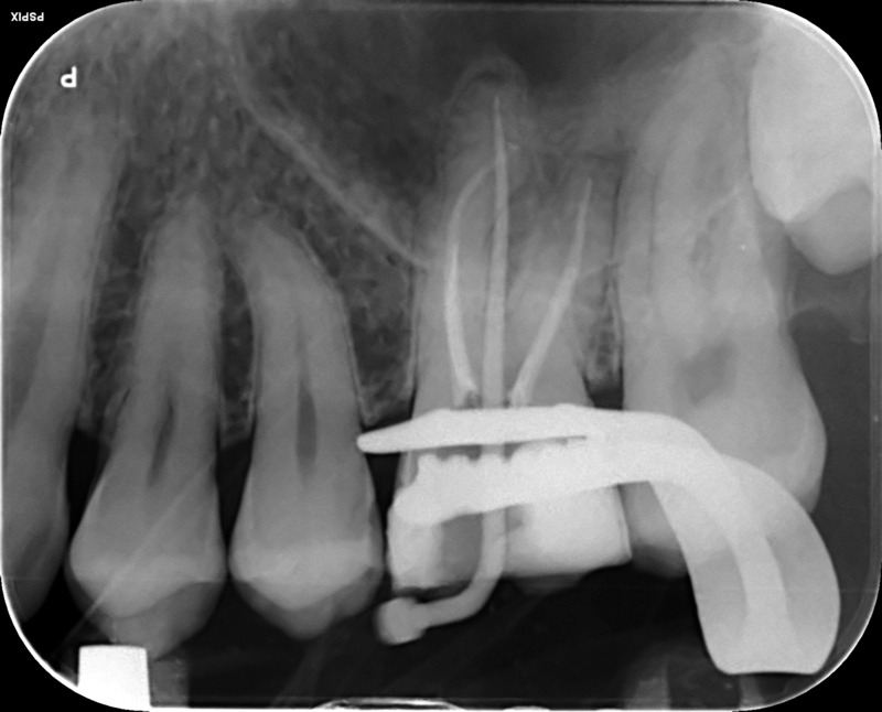 UL6 internal inflammatory resorption case image 4